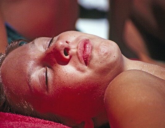 Eritema-solare-rimedi