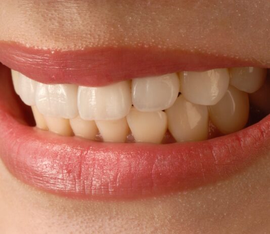 Malocclusione